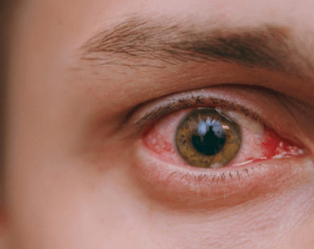 Imagen de una persona con ojos rojos y un ojo rojo debido a la carnosidad en los ojos