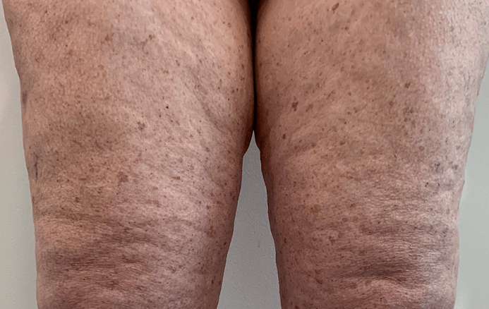 Imagen de una mujer con piernas gruesas y cuerpo delgado debido al lipedema