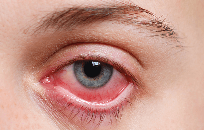 La Carnosidad en los Ojos: Causas, Tratamientos y Mitos a la Luz de la Ciencia